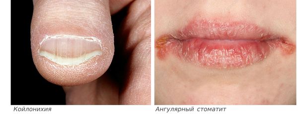 Симптомы анемии — койлонихия и ангулярный стоматит
